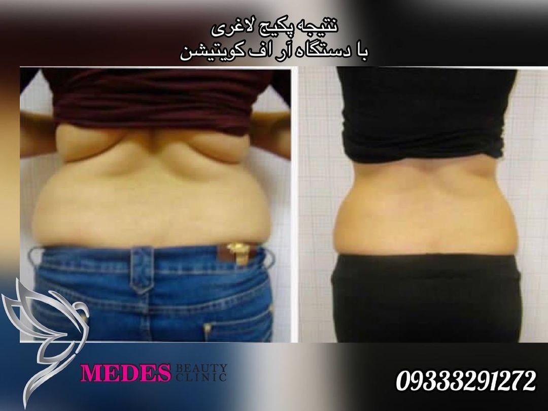 گالری لاغری با دستگاه